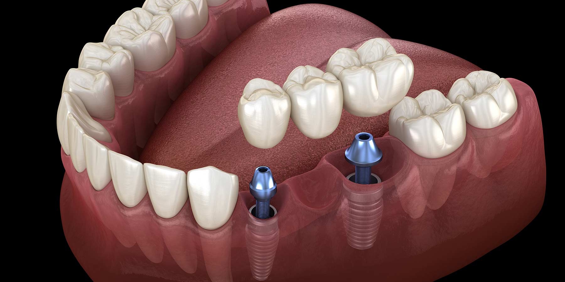 Multiple Implants